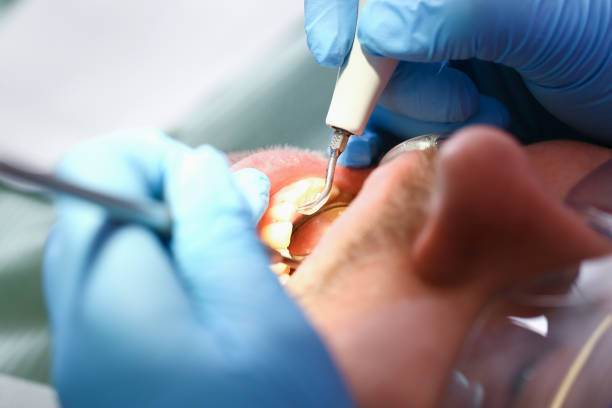Best Emergency Gum Treatment in Happy Valley, CA