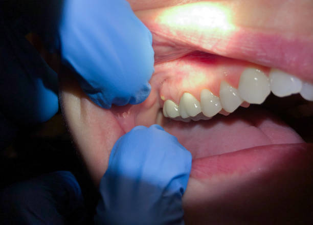 Best Emergency Treatment for Dental Infections or Abscesses in Happy Valley, CA