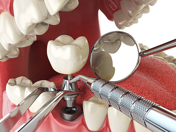 Best Emergency Dental Care for Broken or Chipped Teeth in Happy Valley, CA